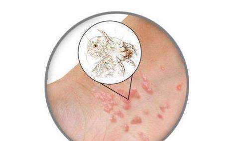 为什么会得疥疮这4大诱因要谨防