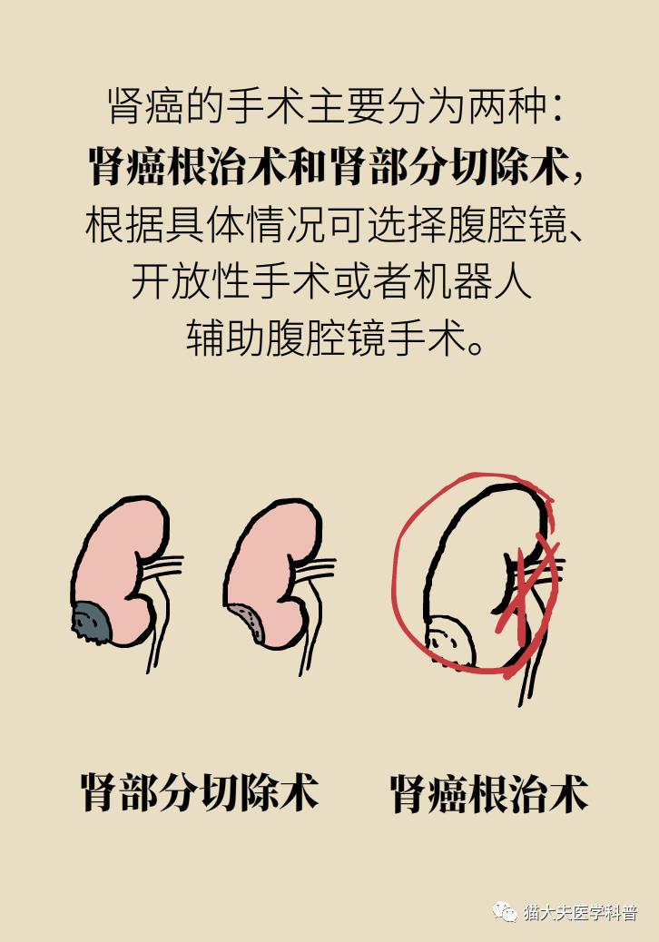 腰子上为啥会长瘤丨肾癌沉默的杀手