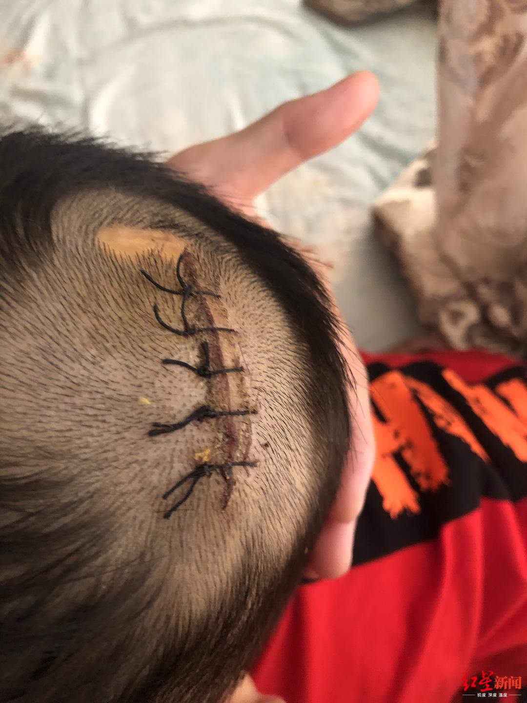 飞来横祸!两岁男孩被凉亭突然脱落的瓷砖砸伤,谁该担责?