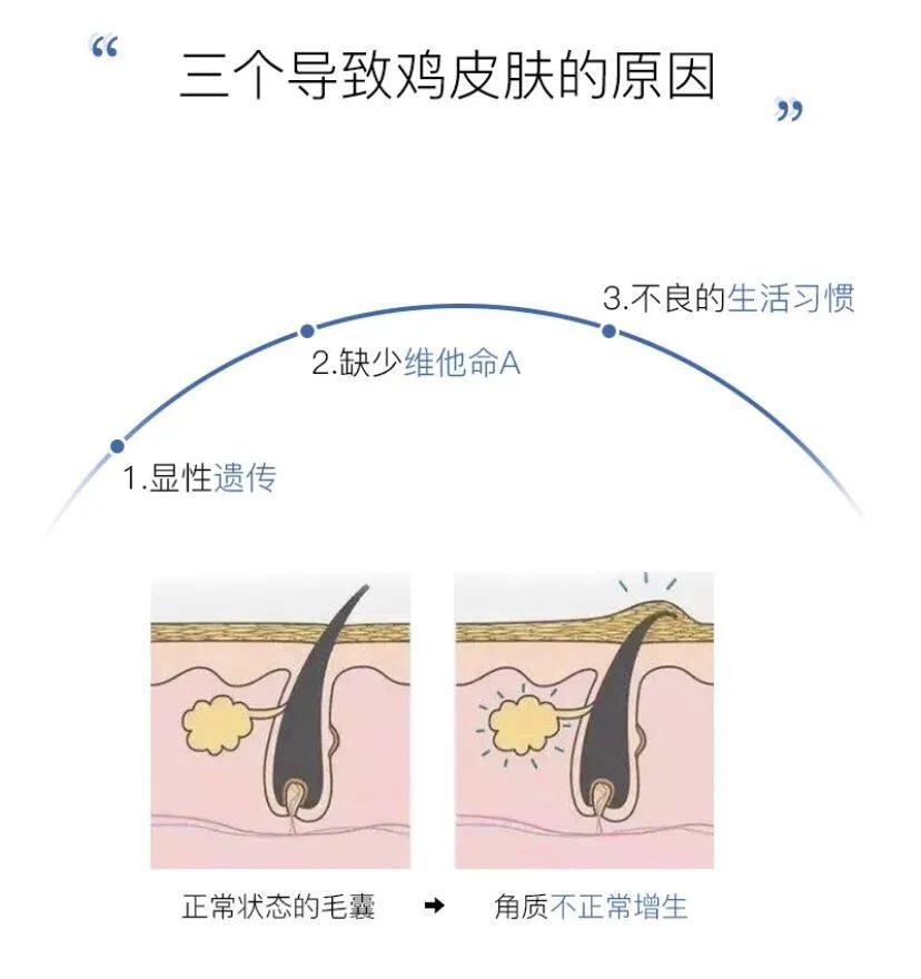 负离子可以改善鸡皮肤吗(负离子可以改善鸡皮肤吗女生) 负离子可以改善鸡皮肤吗(负离子可以改善鸡皮肤吗女生)