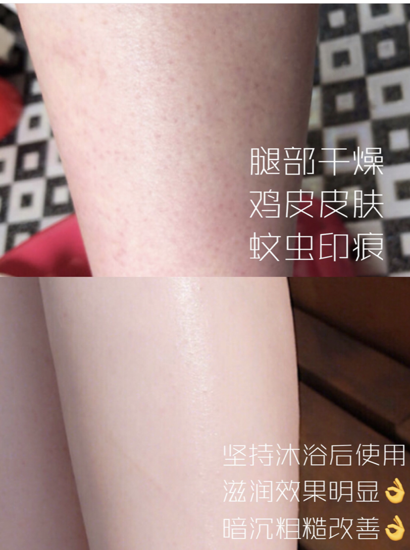 鸡皮肤严重的原因(鸡皮肤越来越严重是什么原因) 鸡皮肤严重的原因(鸡皮肤越来越严重是什么原因)