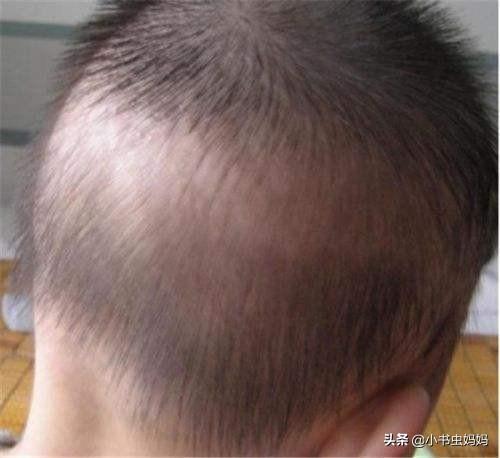 宝宝枕秃,头发少是缺钙?儿科医生:学会4招,让娃拥有健康头发|宝宝|头