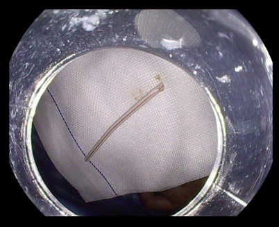 2岁男童吞下棒棒糖杆，内镜中心急诊儿童内镜化解危机休闲区蓝鸢梦想 - Www.slyday.coM