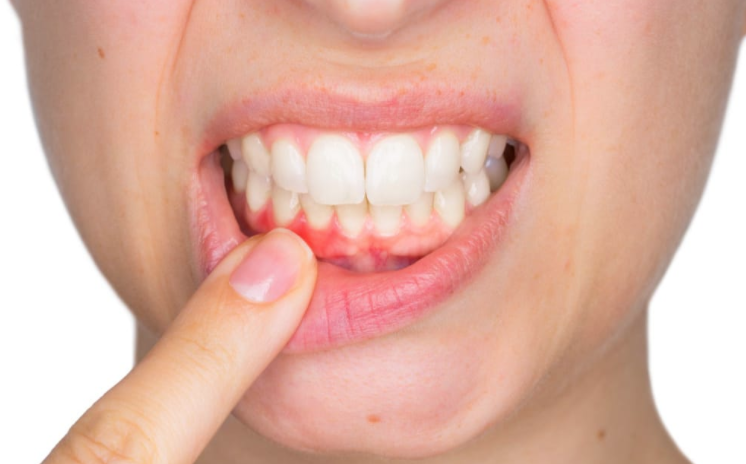 因为性别女,牙更容易坏是真的