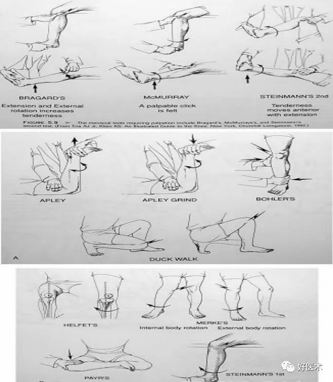 mcmurray test:弹响– 关节线压痛3)半月板外侧副韧带:内翻应力试验 0