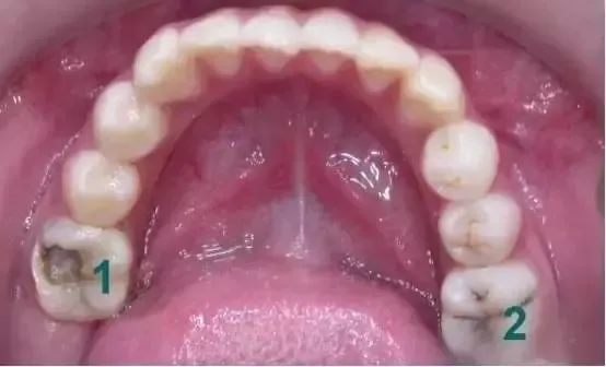 孩子长了双排牙我后悔莫及最伤孩子牙齿的不是糖竟然是