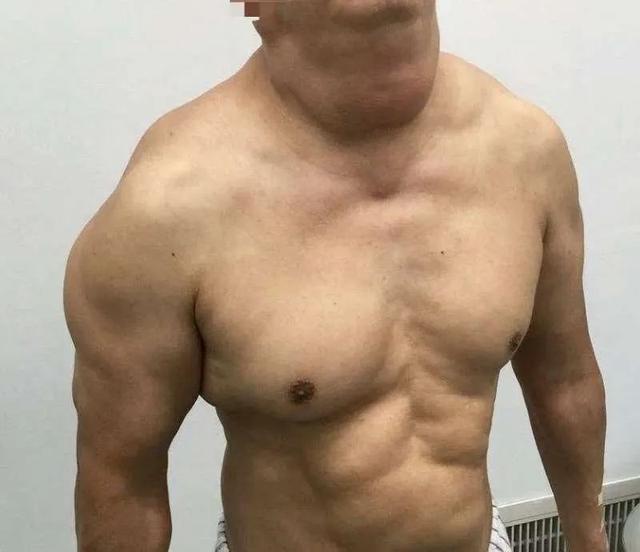 每天喝1斤多白酒，连喝30多年，厦门一大叔脖子粗成“牛颈”！休闲区蓝鸢梦想 - Www.slyday.coM