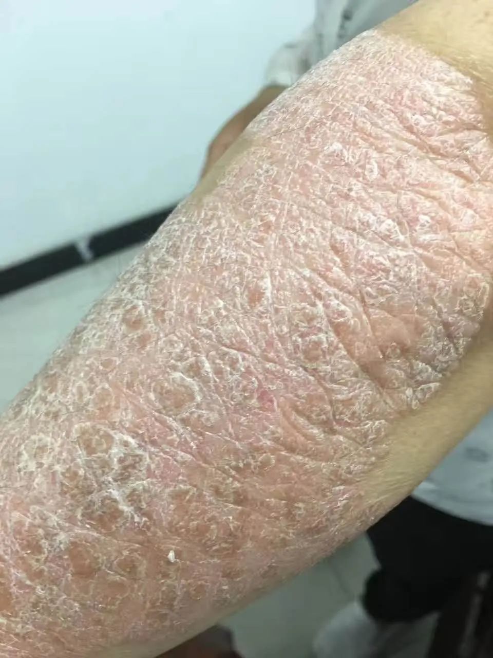 体征,体质,皮损特点,舌脉象等,把银屑病分为血热证,血瘀证,血虚风燥证