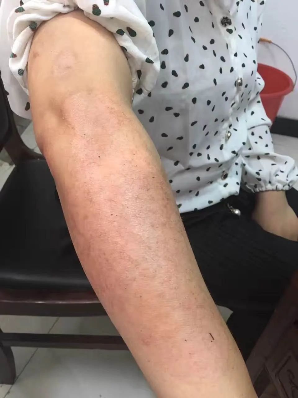 特点,舌脉象等,把银屑病分为血热证,血瘀证,血虚风燥证,湿毒蕴结证