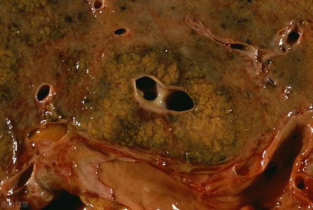 脂肪肝患者肝细胞脂肪变性或坏死,且常伴有脾脏肿大,肝脾功能异常可