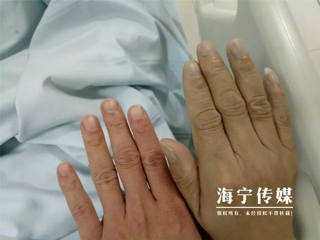 左侧为正常手部皮肤颜色右侧为亚硝酸盐中毒后发青的手部皮肤颜色闻