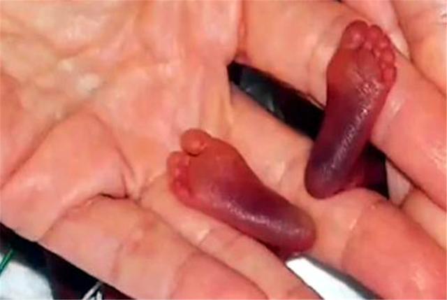 还记得世界上最小宝宝吗?身体还没巴掌大,14年后长大了也变美了