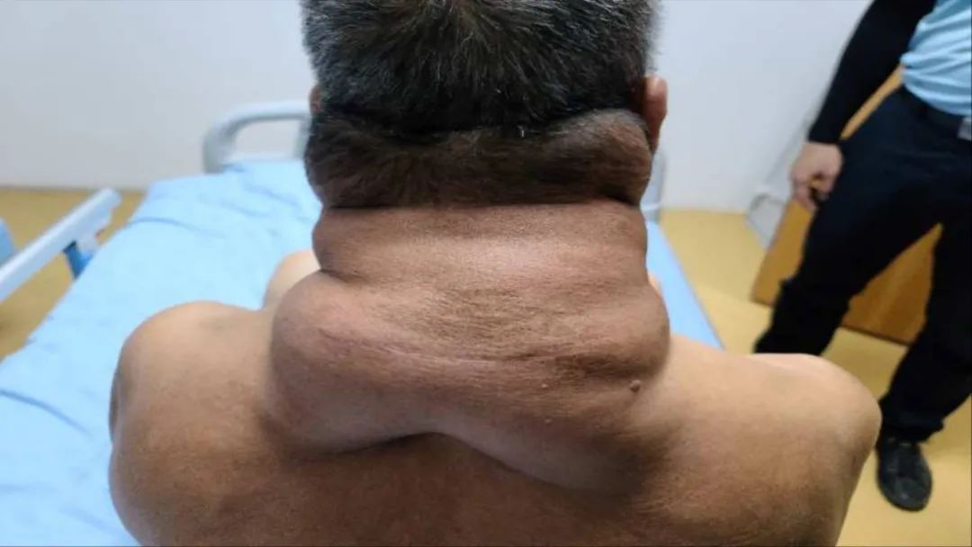 河池一男子脖子长肉项链险变绿巨人罪魁祸首是