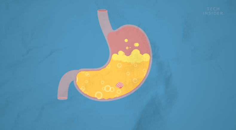 无法被消化的口香糖不小心吞了真的会黏住肠子吗