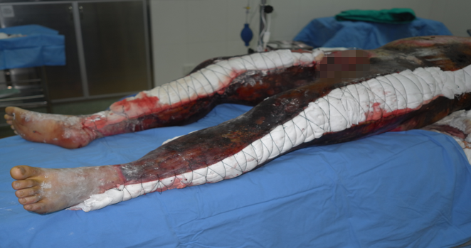 震惊| 被50万伏的高压电击穿!小伙浑身焦黑肿胀,休克超29小时.