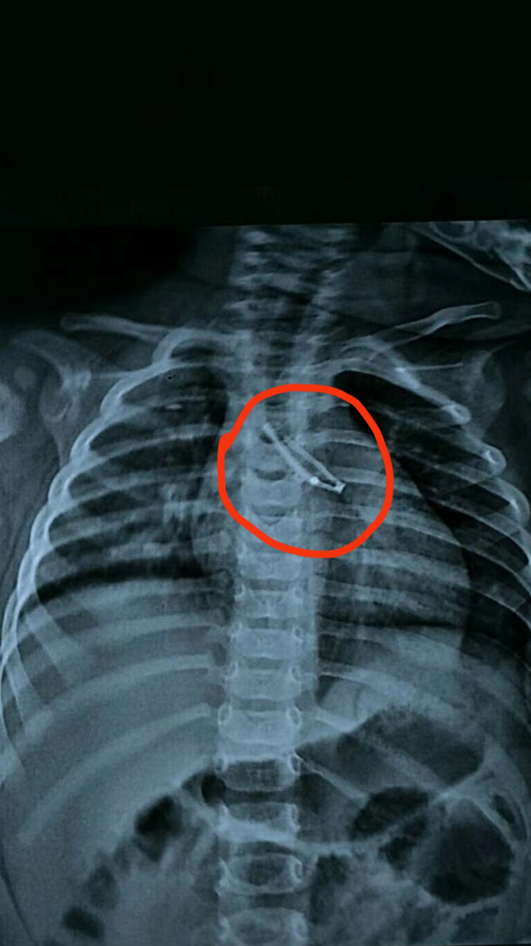 "二极管"藏进8个月宝宝气管,哭闹咳嗽宝妈才发现|气管|异物|二极管