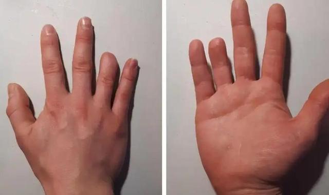 美国男子住院俩月被切掉多只手指新冠的后遗症不容小觑