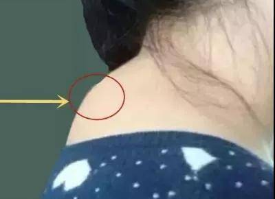 脖子后面的富贵包很要命一招教你铲平