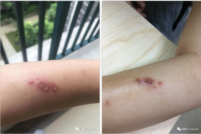 只因随手拍了一只小飞虫女大学生手臂红了一片