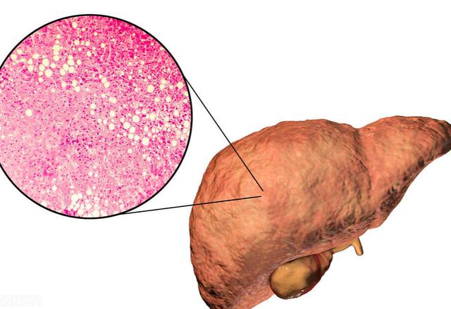 一,脂肪肝人体肝脏内会存储部分脂肪(糖元)来满足血糖等调节,但是如果