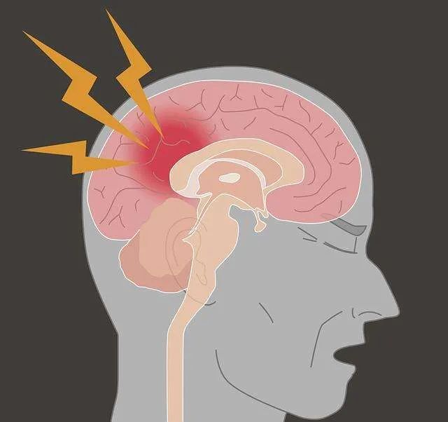 辟谣一到换季就输液这真能预防脑中风
