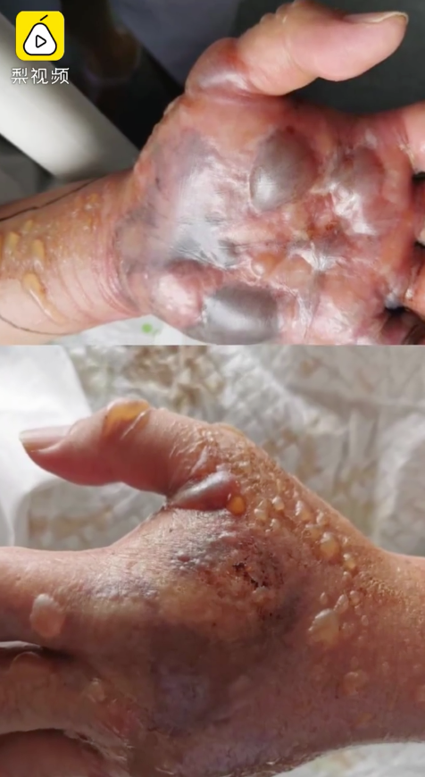 警惕只因被鱼刺扎伤手男子住进icu面临截肢