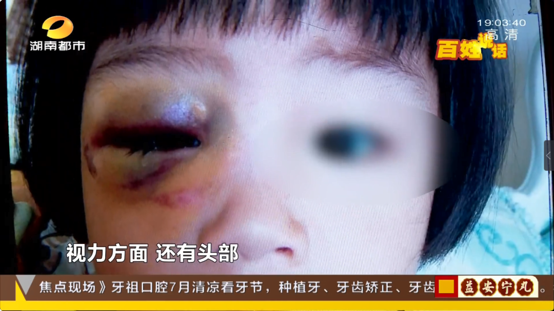 右侧眼眶外侧壁骨折