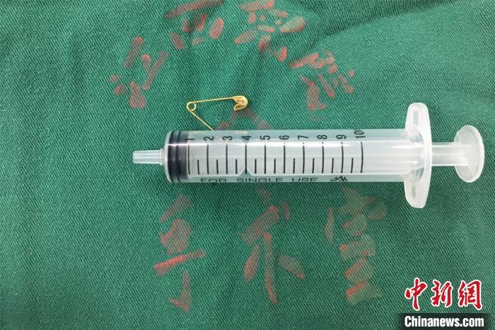 当晚，江西省儿童医院医务人员成功取出患儿食管内的异物，术中多次检查食道，未见活动性出血。　江西省儿童医院供图 摄