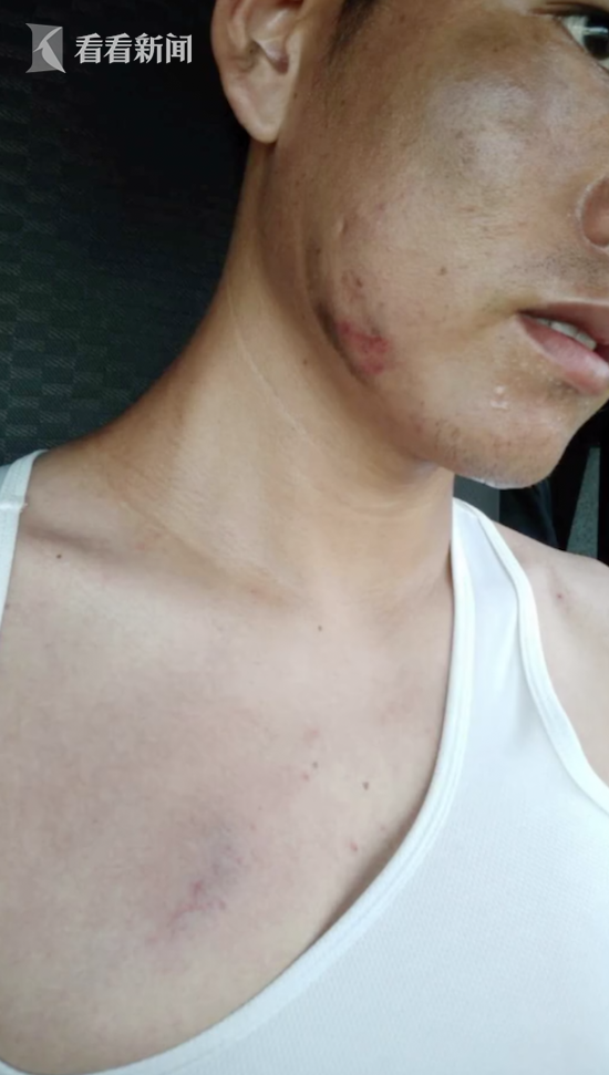 农国切的头盔上有三道刀痕,而他脸部,胸口的淤青,印证了当时的危急