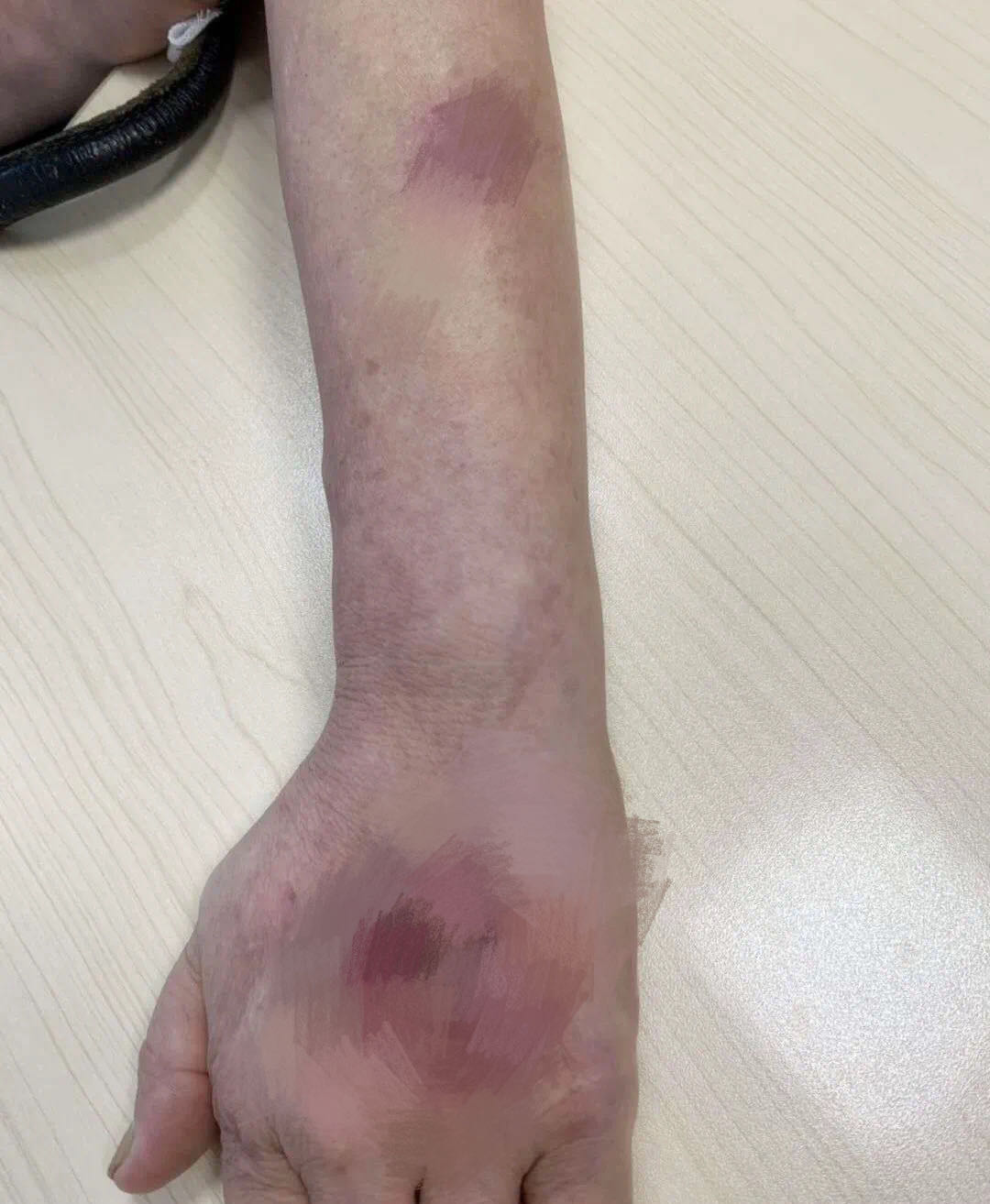 深圳女子做家务后手背溃烂,"罪魁祸首"竟是它