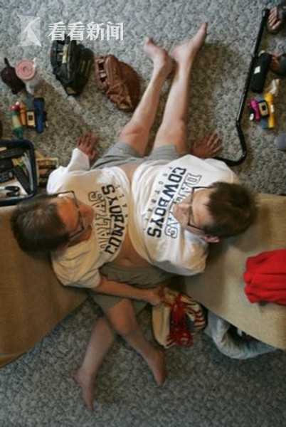 世界最年长连体双胞胎去世各有四肢共用下腹