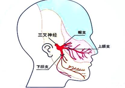 生活中常见的三叉神经痛的诱因有哪些呢?|三叉神经痛_新浪新闻