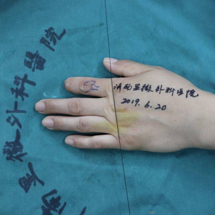 手指术前术后对比:术前在脚趾取材:门诊以"左手示指末节缺损"收入院