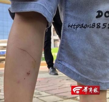 西安2岁半孩子被狗扑倒回家后发现娃腿被狗咬伤