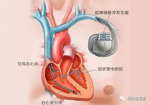 韩国研发太阳能"无线"充电心脏起搏器