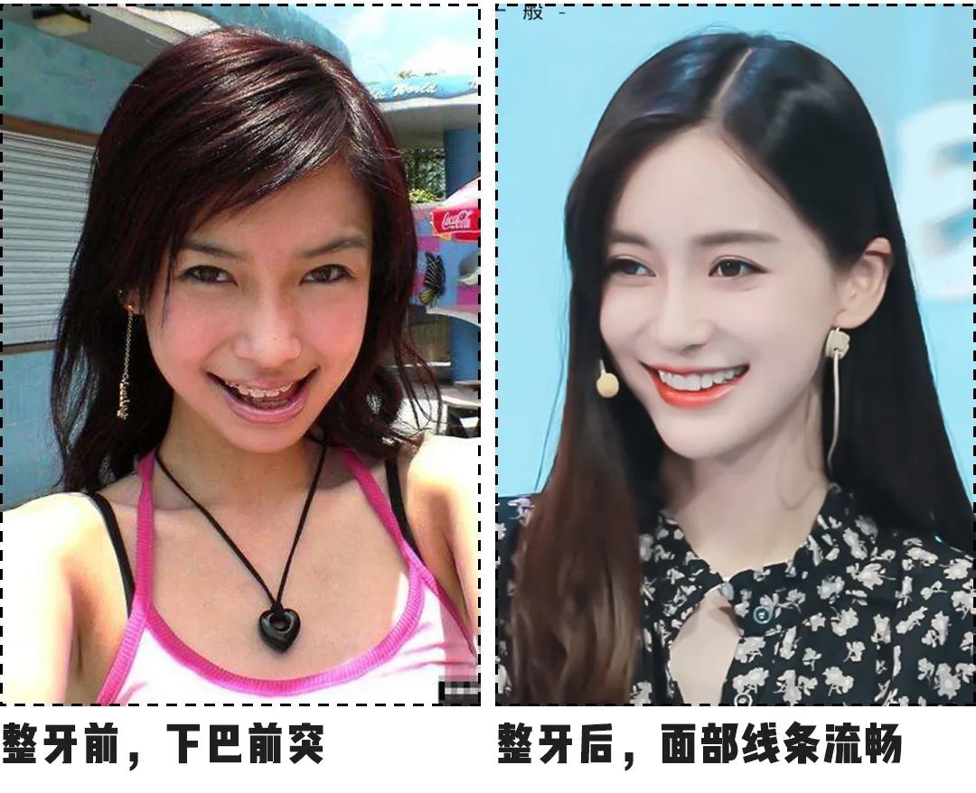 整牙=换张脸?尤其是有这2个特点的女生!
