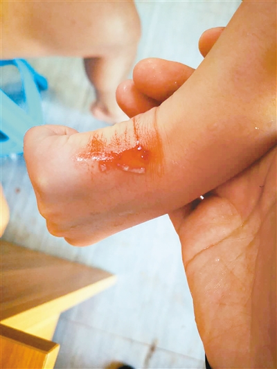 小女孩在水世界游玩时受伤 相关损失究竟该谁赔?