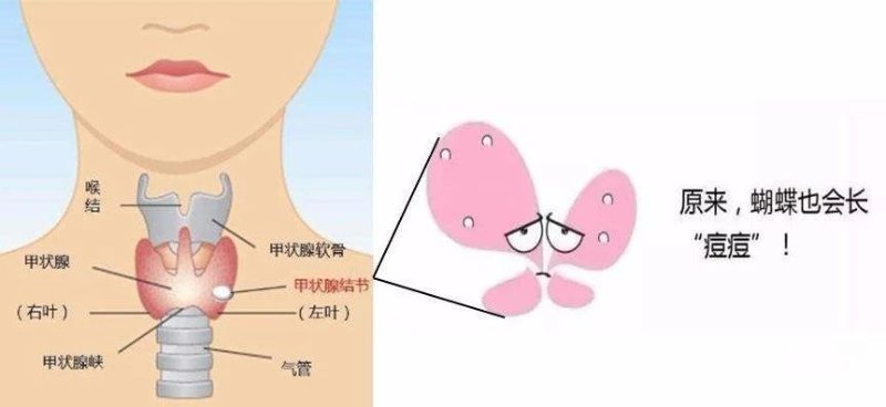 甲状腺结节|甲状腺|结节_新浪新闻
