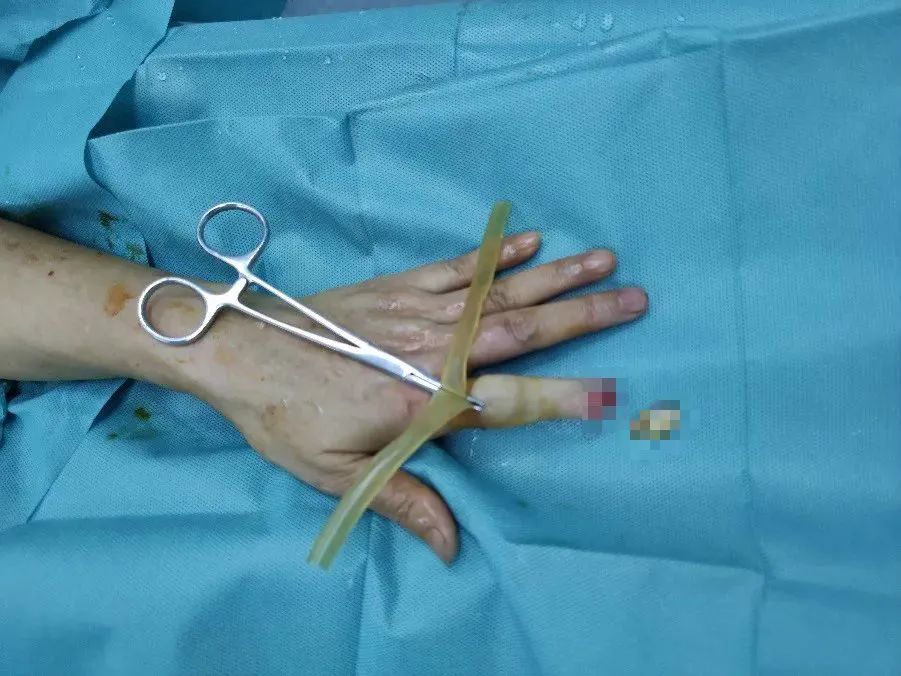 爱做饭的人注意深圳女子切菜时没留心险些毁了一根手指