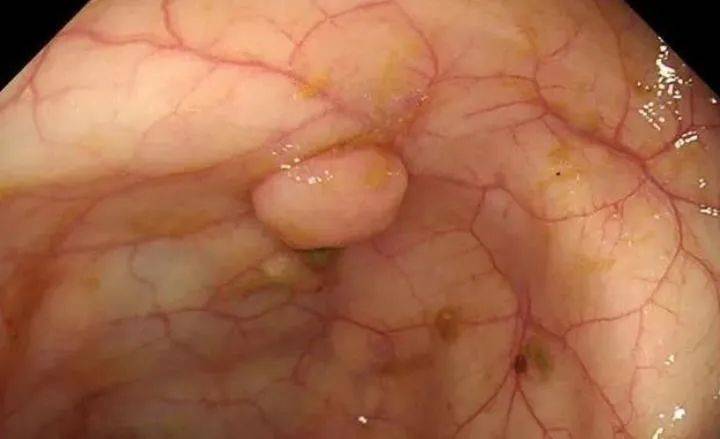 肠癌,就是个傻子癌!好防,也好治