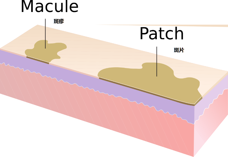 斑疹,图片来源 wikimedia commons