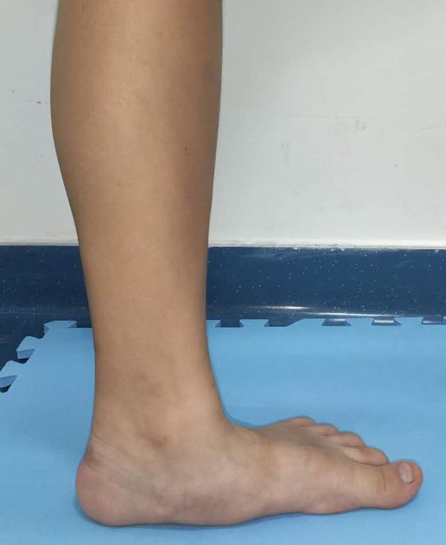 而扁平足患者,站立时,足内侧足弓是变浅,严重的甚至是完全消失的,如下