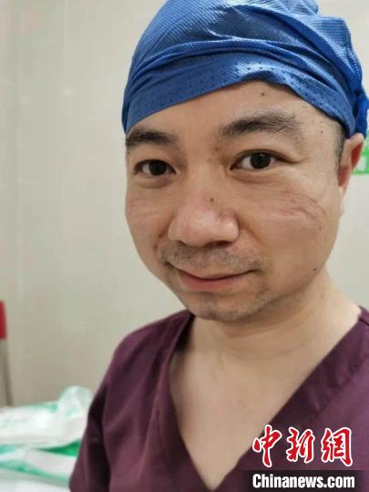 走出隔离病房摘下口罩后,叶盛脸上满是勒痕.浙大儿院 供图