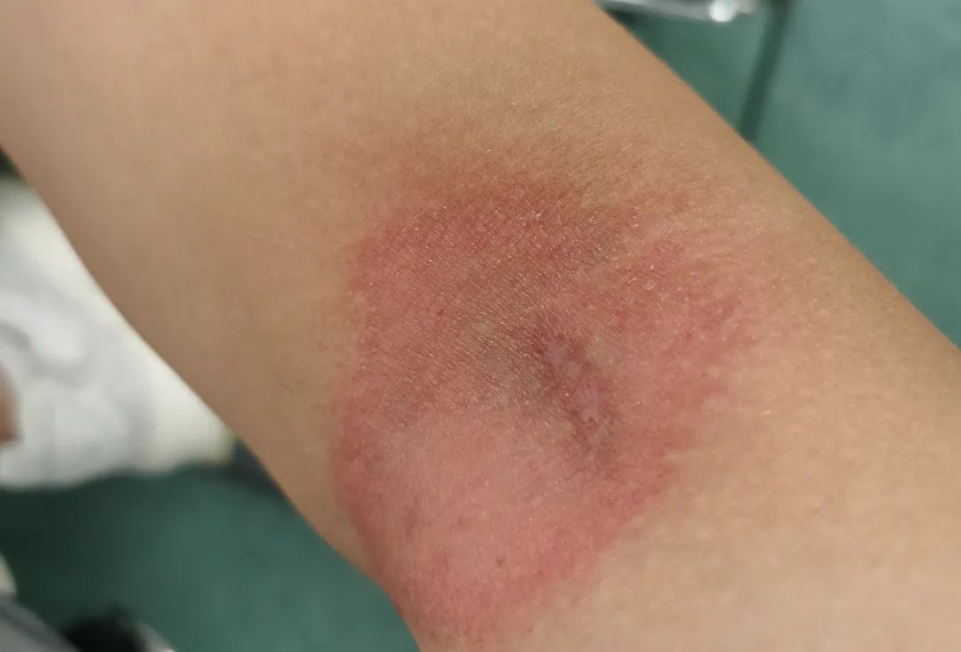 深圳又有人被这种虫子咬了遇到它千万别直接拍死