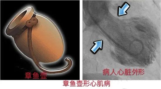 悲伤真会令人心碎,心碎综合征需要预防!