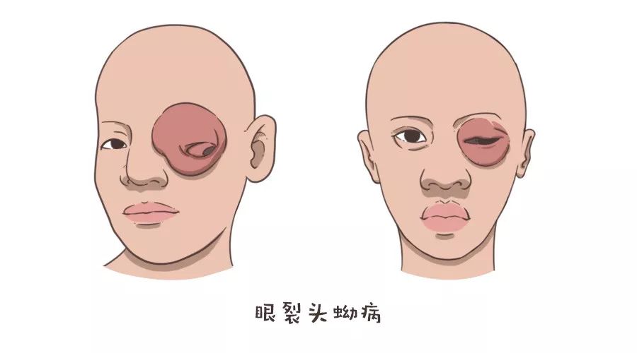 胸腹等部位易见,肉眼可见鸽蛋大小的移动肿块,肿块里面就是裂头蚴寄生