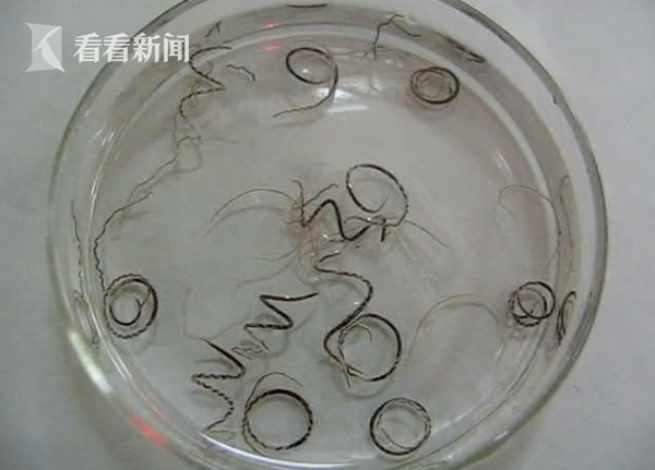 小伙常年喝生水致脑中布满寄生虫全球仅3000例 手机新浪网 小伙常年喝生水致脑中布满寄生虫全球仅3000例 手机新浪网