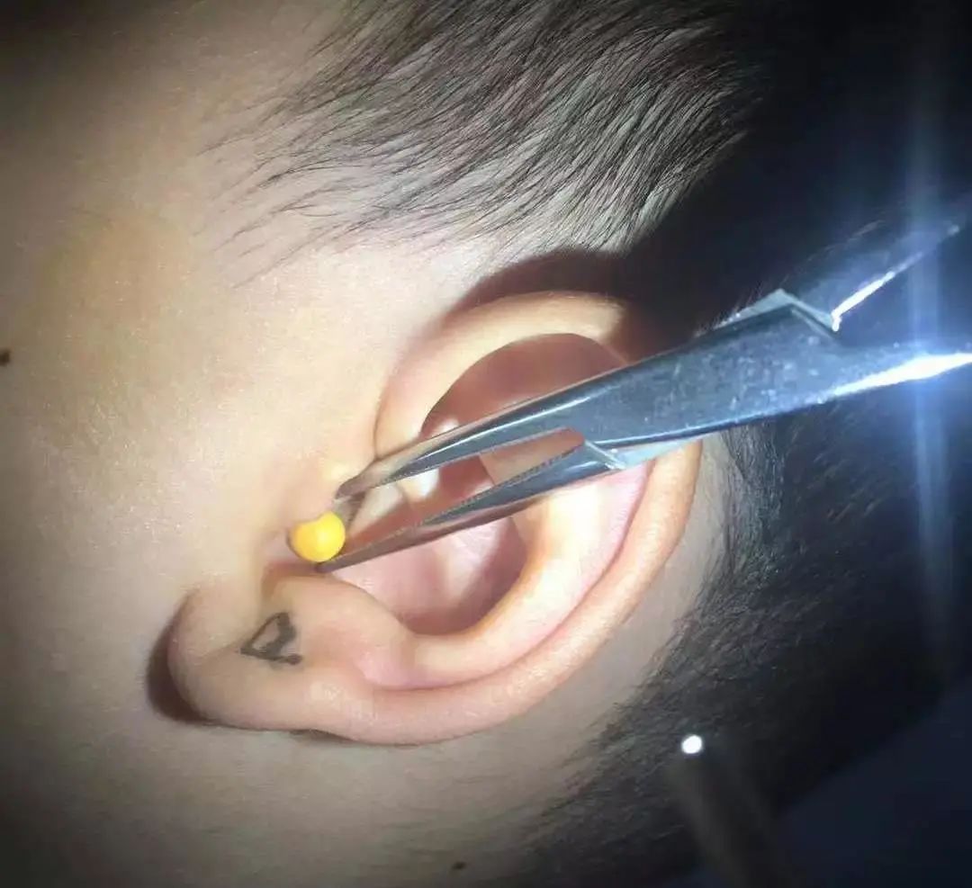男孩模仿孙悟空,把"金箍棒"塞进耳朵里!医生紧急提醒