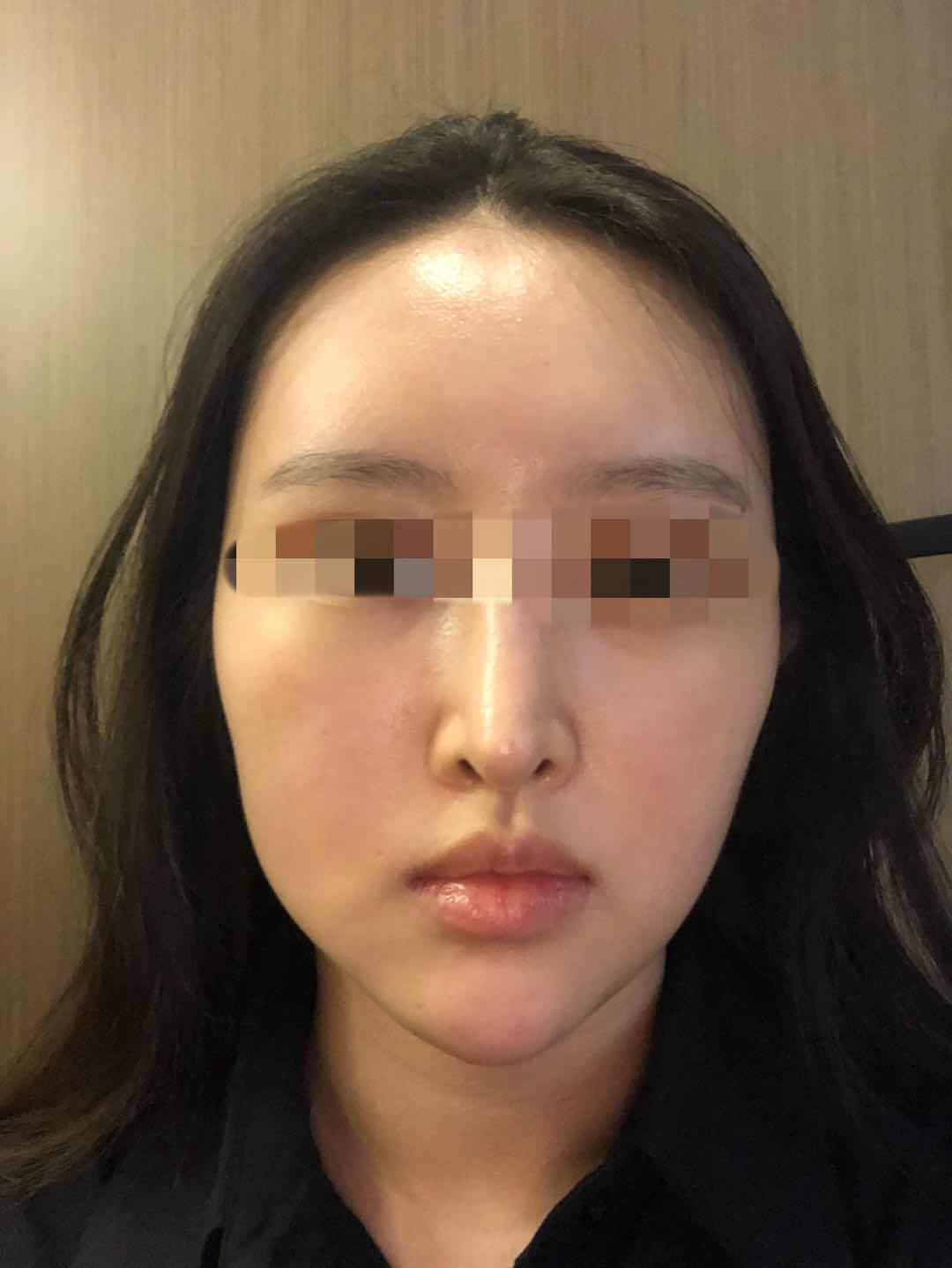 术后唐云出现面部下垂,双颊不对称等情况