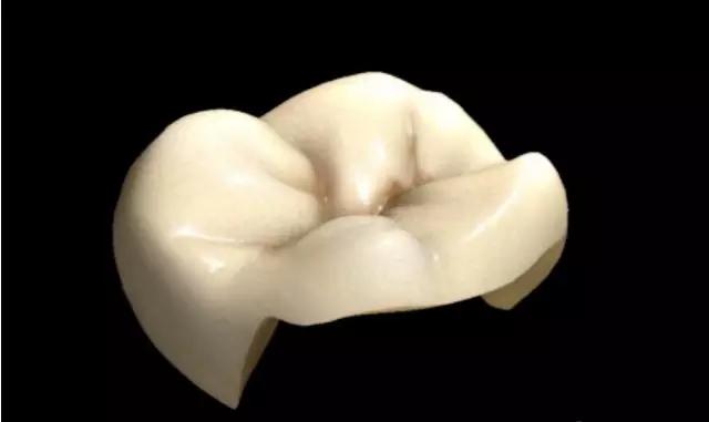 有一种补牙叫"嵌体"